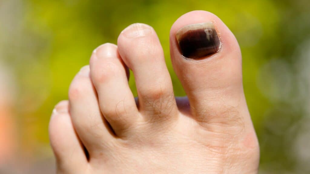 Skiers Toe: Symptoms and Treatment by a Foot Specialist