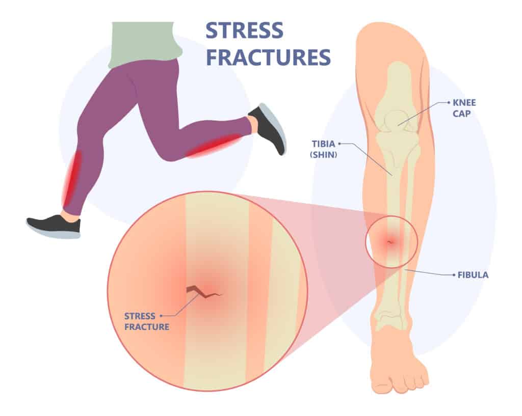 Stress Fracture Shin Diagram