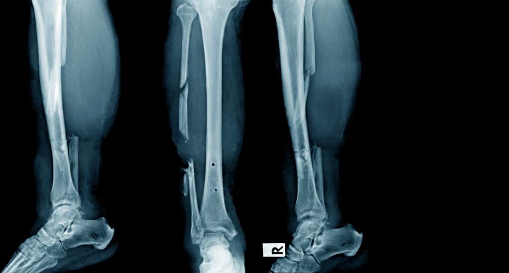 X-ray of comminuted fracture
