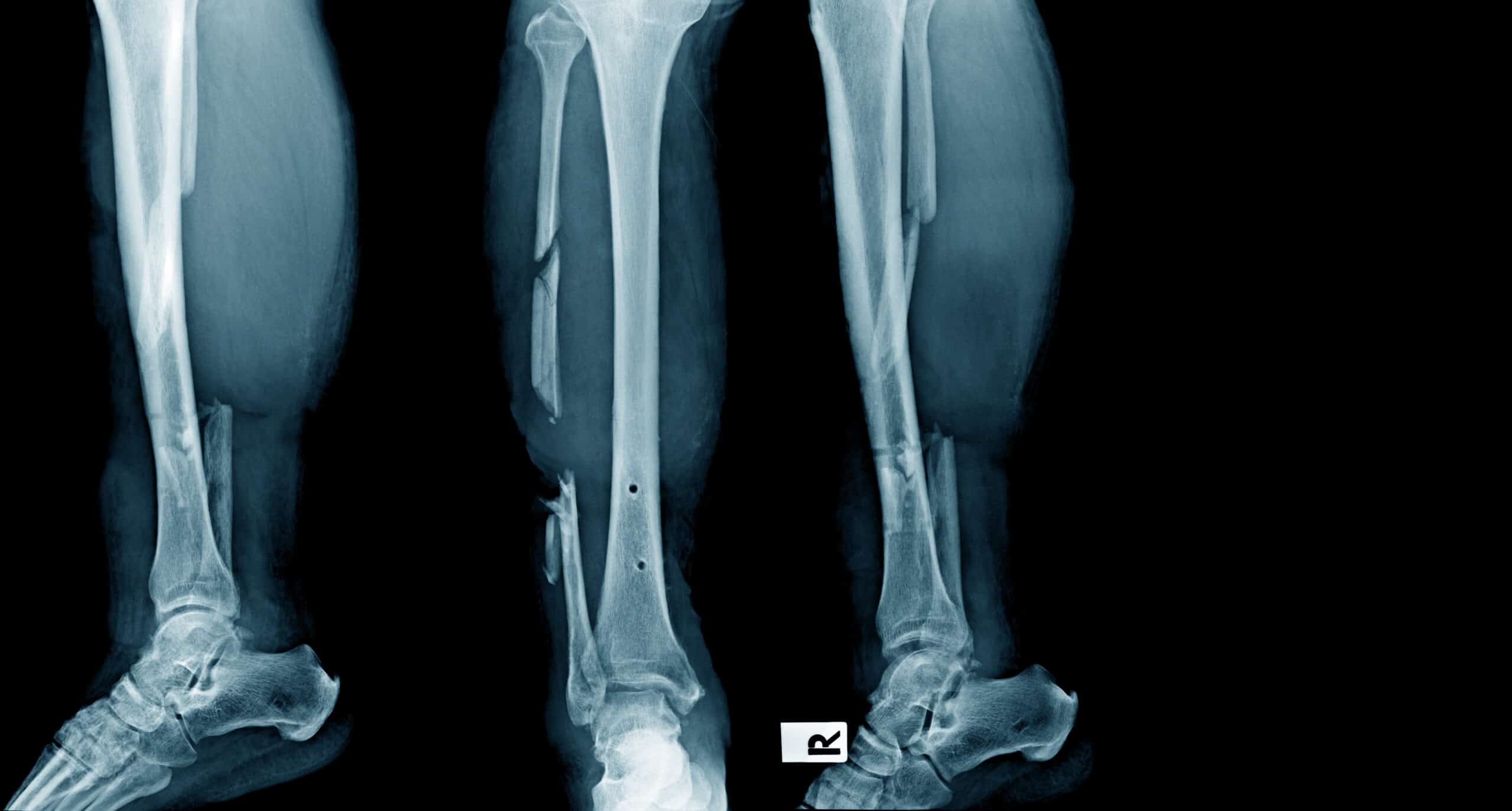 communited-fracture-causes-symptoms-treatment-explained