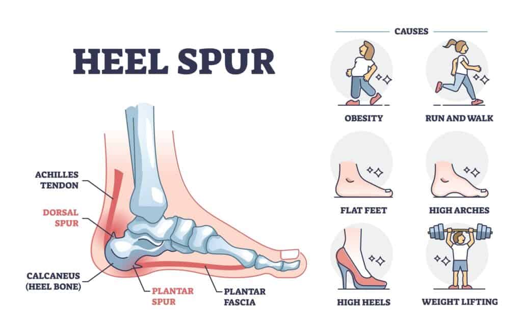 Heel Spurs: Causes, Symptoms, and Treatment