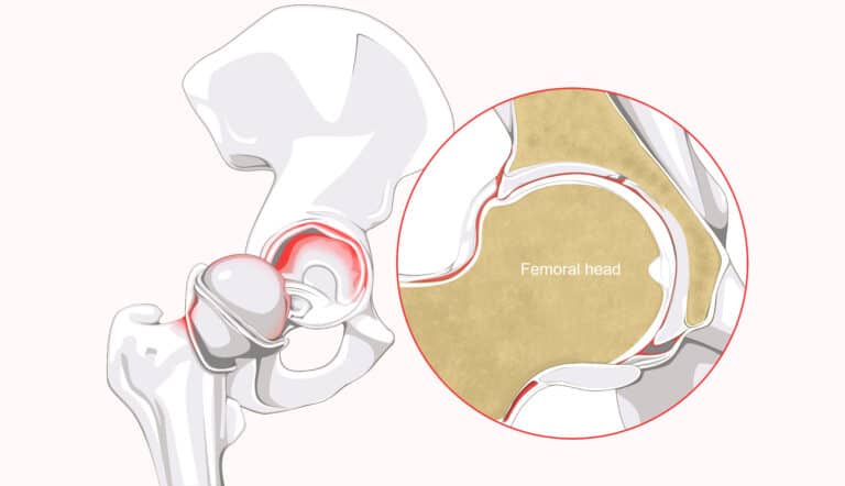 Hip Labral Tear Anatomy And Symptoms 0522