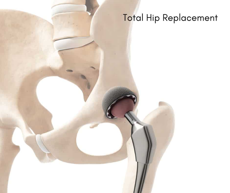 Avascular Necrosis Hip | Symptoms, Risk Factors and Diagnosis