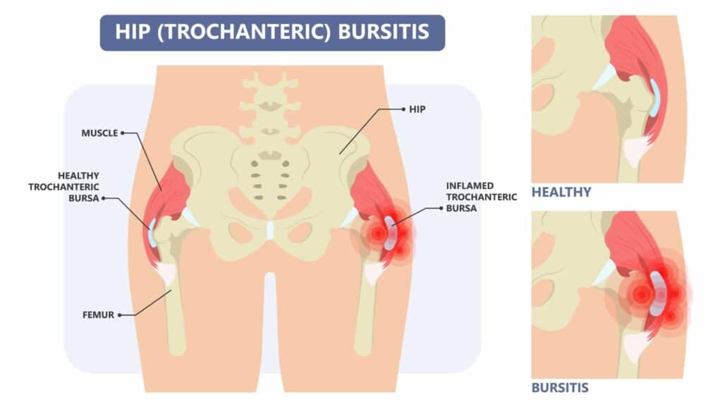 Diagram of trochanteric hip bursitis