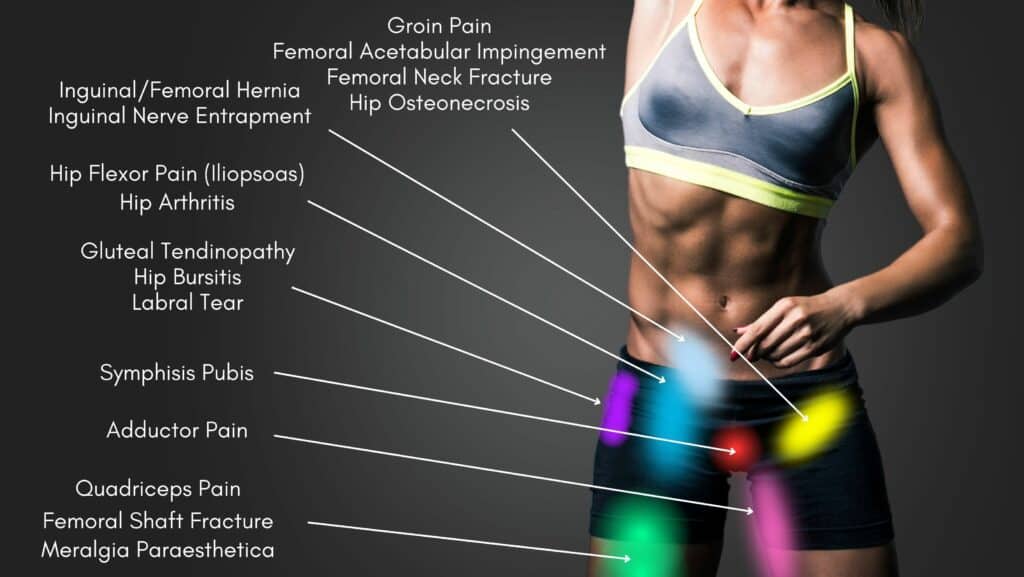 Hip Pain Location Diagram Anterior View