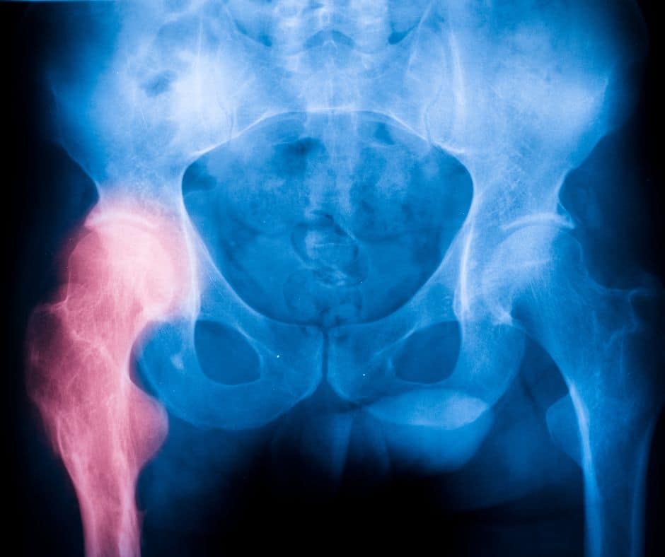 hip-stress-fracture-stress-fracture-in-hip