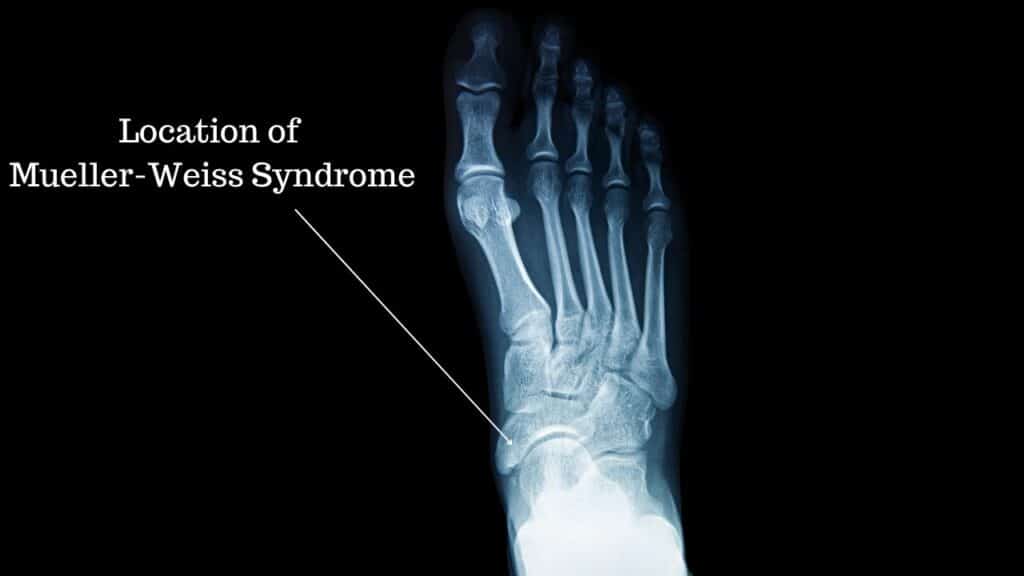 Diagram of the location of Mueller weiss Syndrome