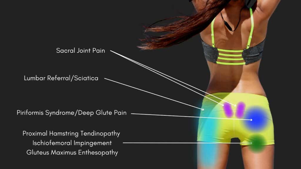 Hip Pain Location Diagram Posterior View